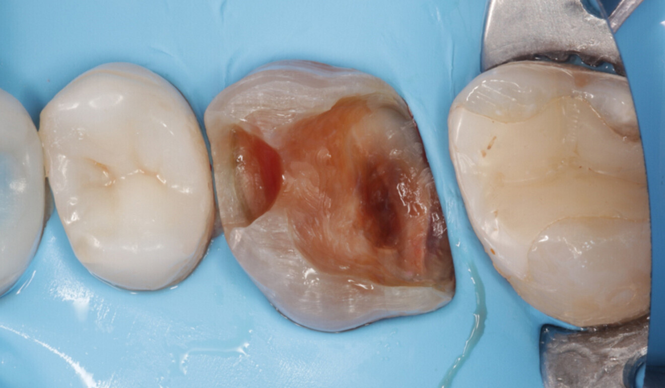 Fig. 6: Dental dam newly placed in the interproximal area. Full isolation is essential for the excavation of the infected dentine in the deepest part of the cavity. (Image: Kuraray Noritake Dental)