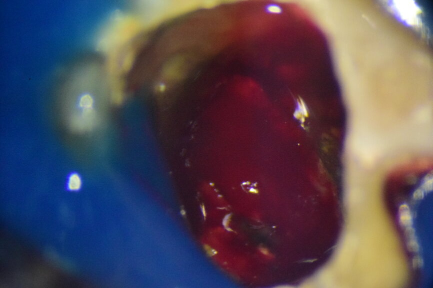 Fig. 3: Intra-op image of tooth #46 captured under the dental operating microscope at 16× magnification.
