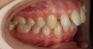 Torque control of maxillary incisors during space closure in a patient with maxillary protrusion treated with aligners in nine months