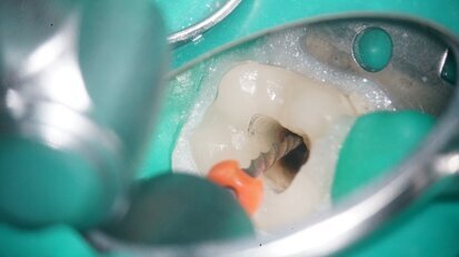 Retreatment of a carrier-based root filling with bypassing of two ledges
