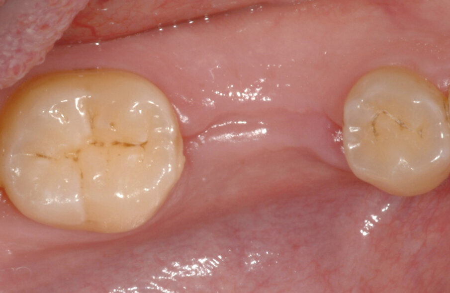 Fig. 4: After eight weeks of healing, the soft tissue over the extraction area was completely healed.