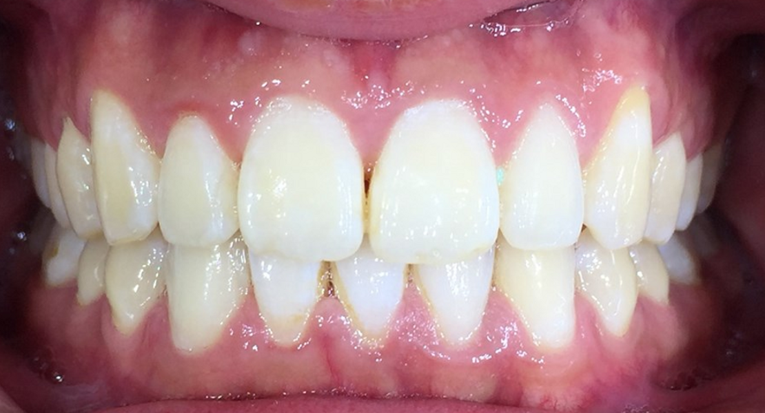 Fig. 24: Close-up view of the patient’s smile after aligner treatment.