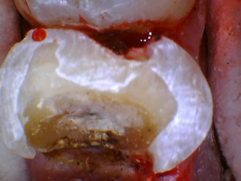 Fig. 4: Affected leathery dentine overlying the pulpal area mesially.