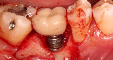 Estudo determina os motivos das técnicas de remoção e falha de implantes dentários
