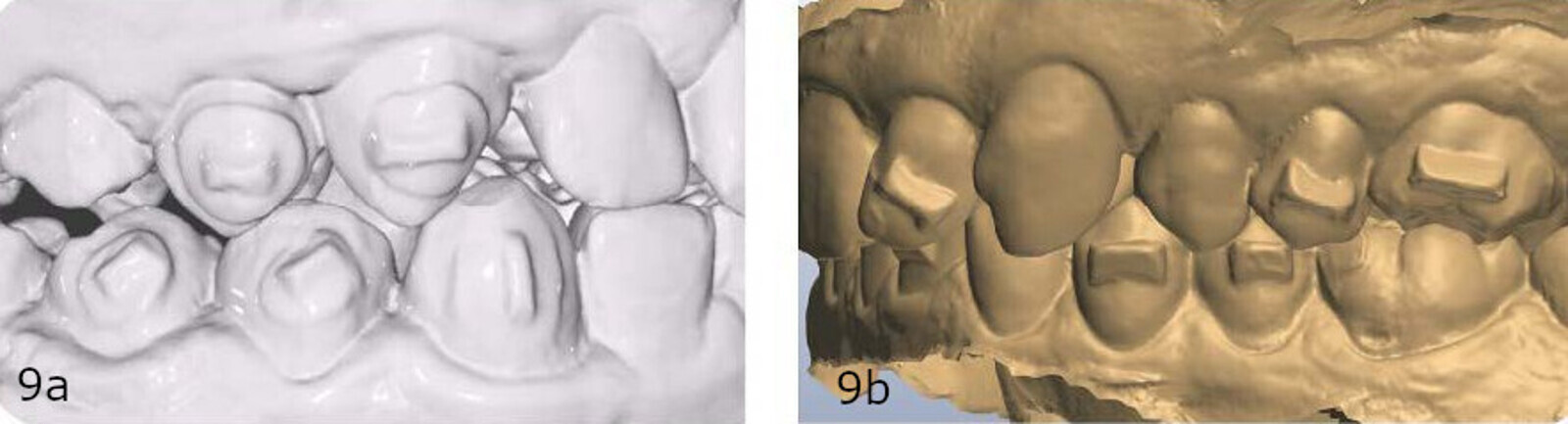 Figs. 9a & b: (a) Scan of conventionally moulded attachments and (b) of Clarity Precision Grip Attachments. Both scans were taken prior to any flash removal.