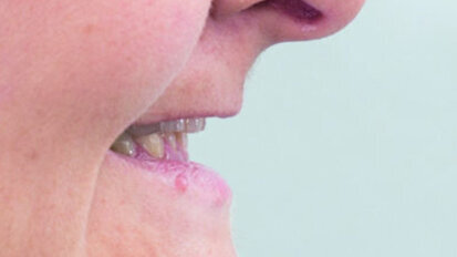 Combined CAD/CAM-assisted treatment, for a new, beautiful smile