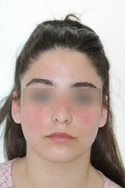 Fig. 19: Final situation after 25 Reveal aligners.
