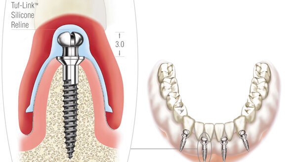 Le Système Atlas Denture Confort