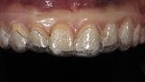 Figs. 6a y 6b. Ajuste intraoral de la guía quirúrgica para alargamiento de coronas.