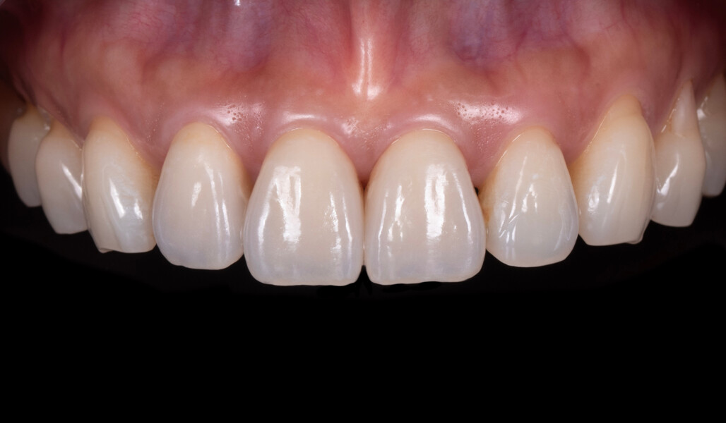 Fig. 10: Crowns after adhesive cementation with PANAVIA V5 (Kuraray Noritake Dental).