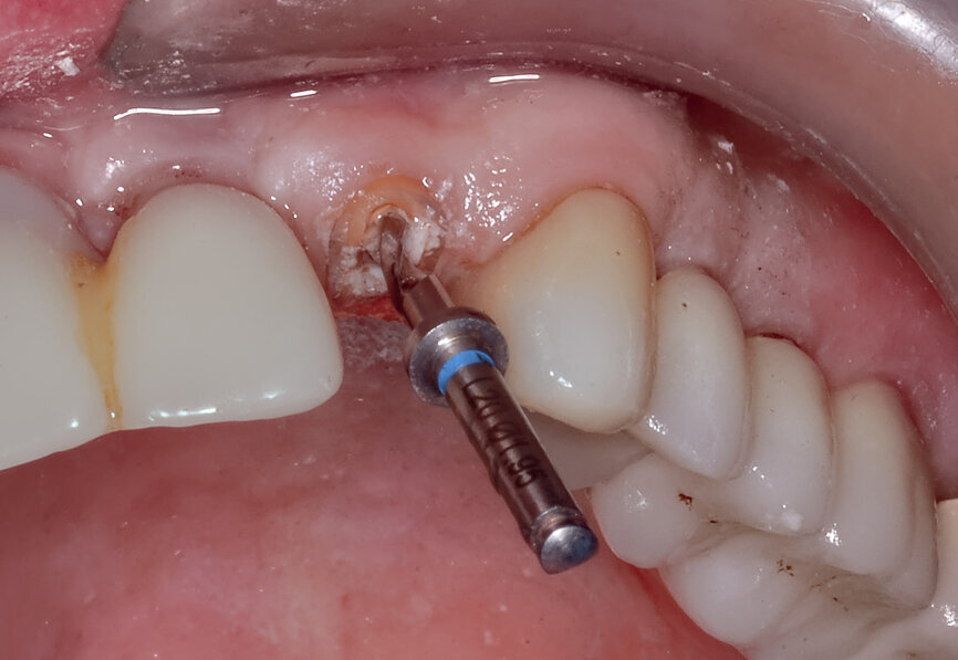 Fig. 7b: Removing the guide allowed for inspection of the drill embedded within the tooth.