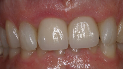Esthetic management of adjacent maxillary central incisors: Extraction, immediate placement and immediate provisionalization