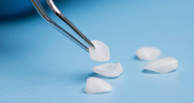 Six-year follow-up highlights durability of veneers in a complex aesthetic case