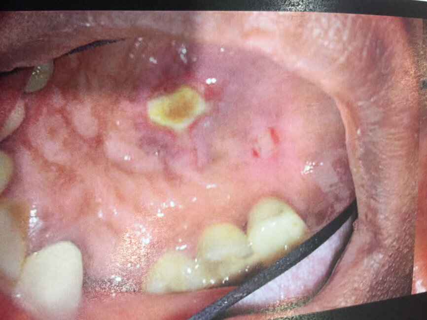 Fig. 2: Sodium hypochlorite accident approximately five months post op, intra oral (different case than that shown in Fig. 1).