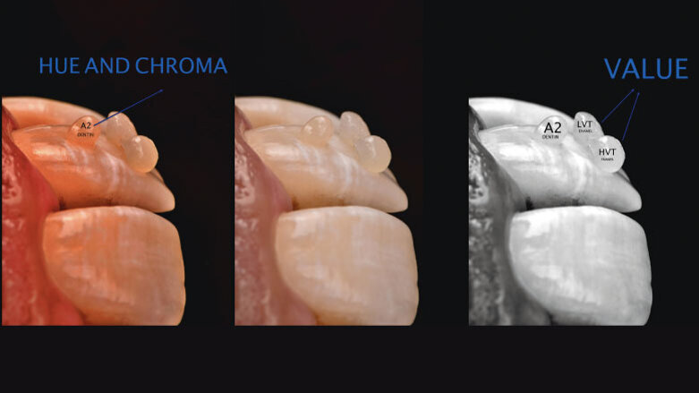 Smile rejuvenation with  Biosmart restoratives