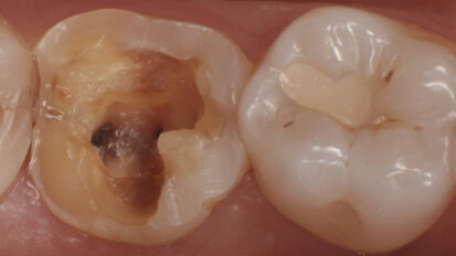 Indirect adhesive restoration in the posterior region: The power of universal materials in a digital workflow