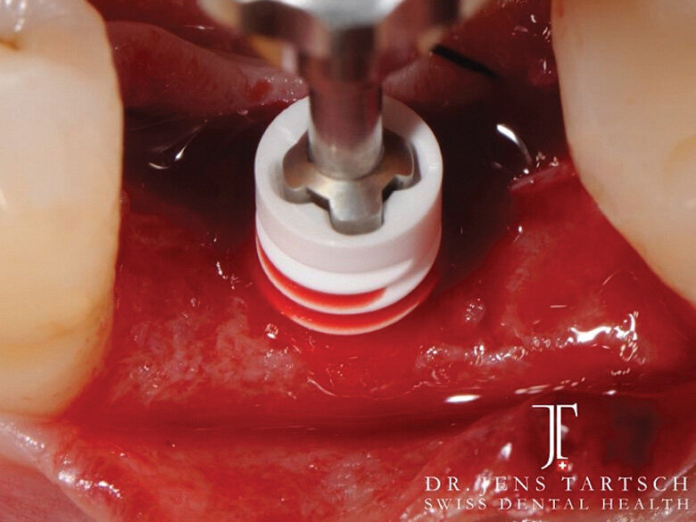 Fig. 4: Insertion with bolt in tube; inserting instrument max torque 25 Ncm. (Photo: Jens Tartsch, DMD)