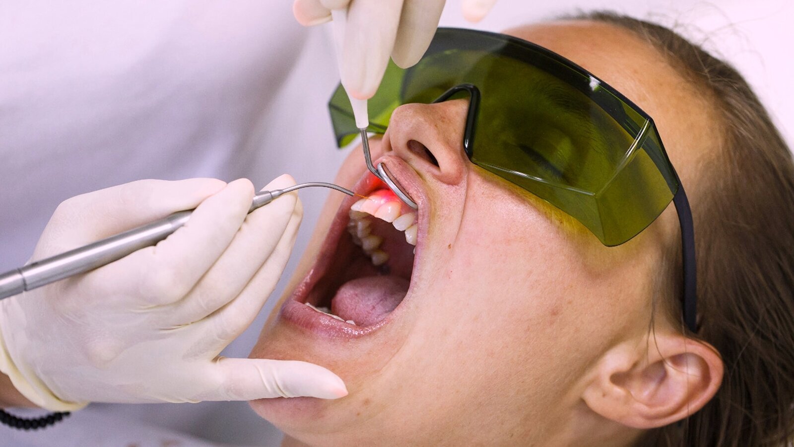El uso del láser en Periodoncia (6)