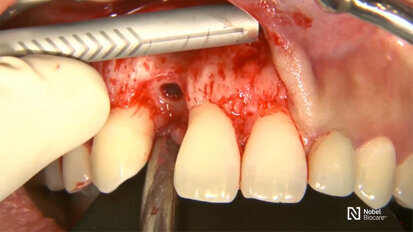 Nobel Biocare - Guided bone regeneration with simultaneous implant placement