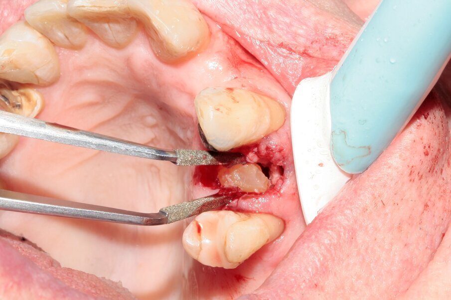 Figs. 13–15: The remains of the root were removed with the help of diamond tweezers.