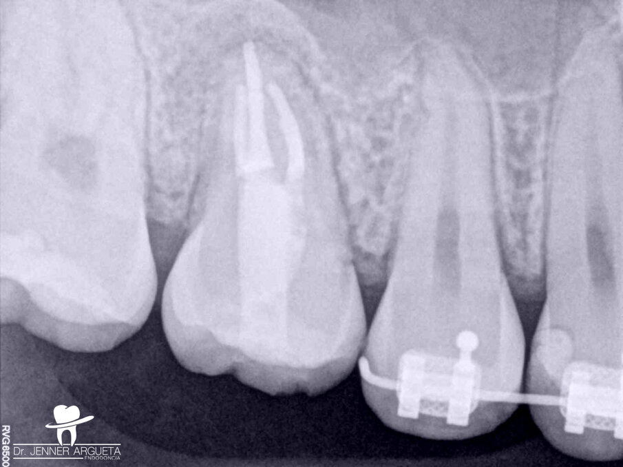 Fig. 9: Final radiograph of the root canal therapy and coronal restoration. Placing the coronal filling material into the pulp chamber tends to be complex with such a small access opening.