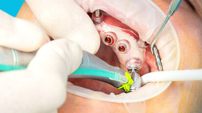 Redefining implant therapy with digital planning, guided placement and use of CONNECT abutments