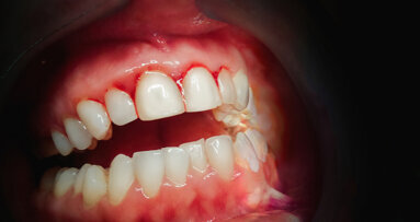 Oxidative stress links periodontal and chronic kidney disease