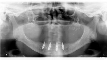 Analiza porównawcza występowania periimplantitis – kliniczne obserwacje 4-letnie