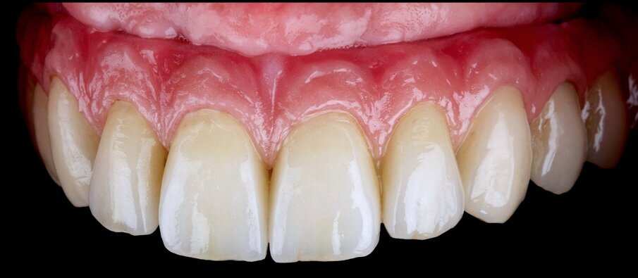 Fig. 19: Intra-oral view after treatment.