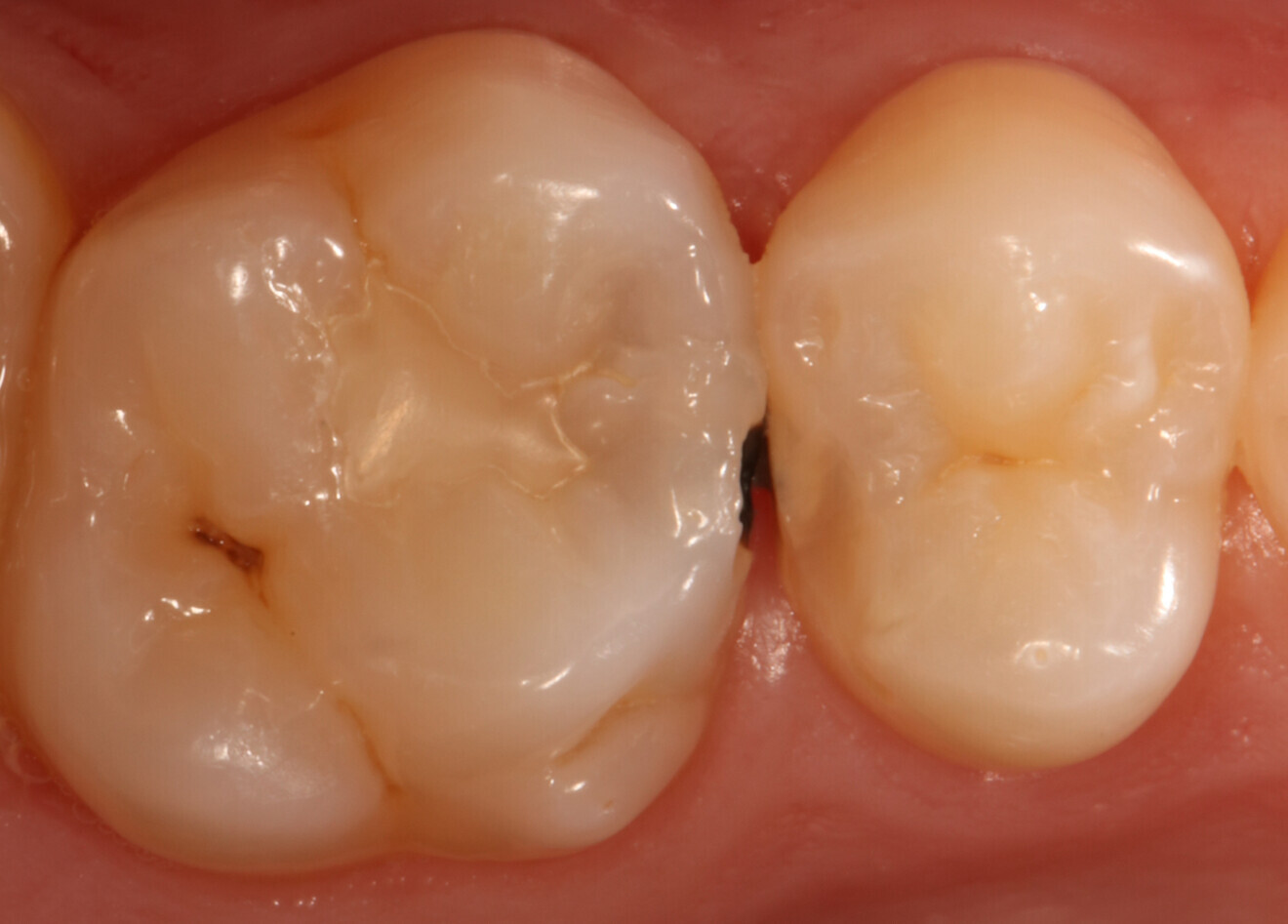 Fig. 1, a–c: Treatment of a high caries risk patient with EQUIA Forte TH. (Images: Zeynep Bilge Kütük)