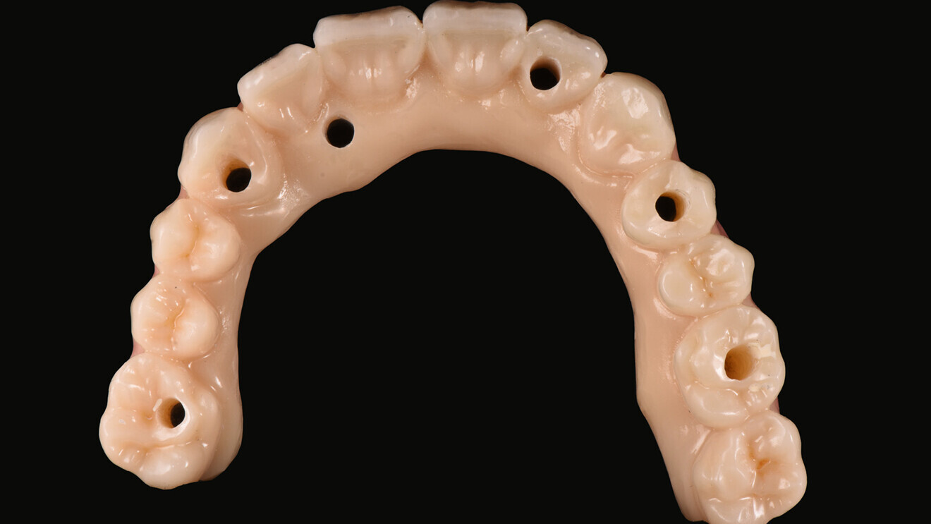 Fig. 1: Occlusal view of an implant-supported overdenture made of KATANA Zirconia HTML PLUS (Kuraray Noritake Dental) for a male patient with an edentulous maxilla and a removable partial denture in the mandible. 
