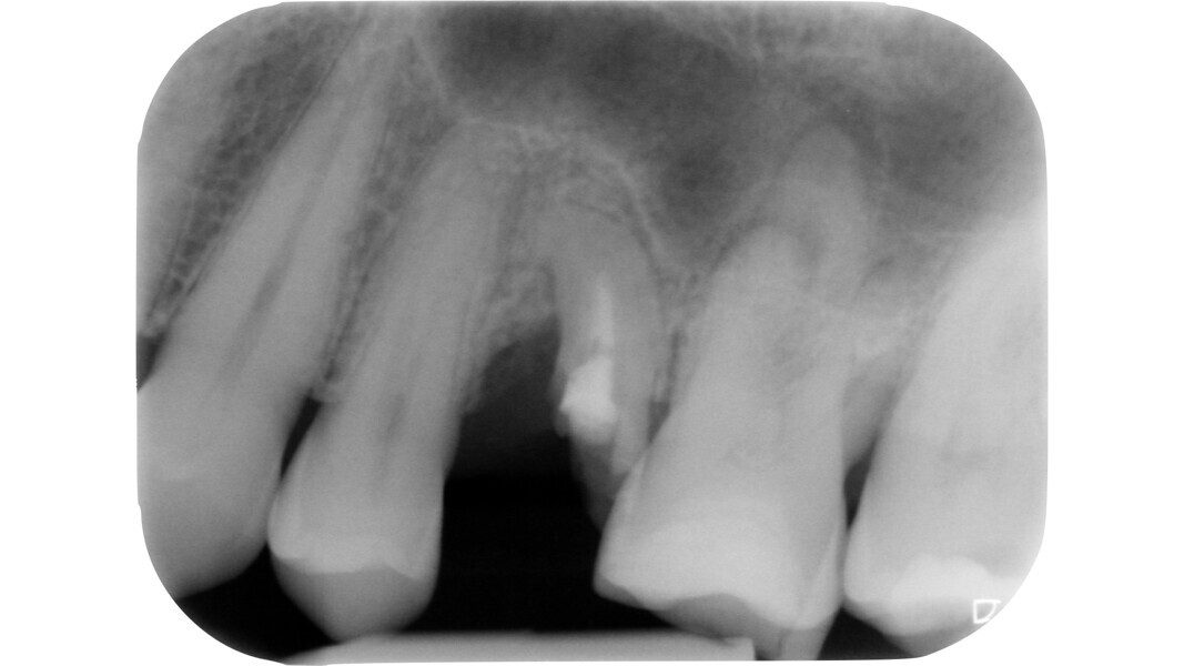 Fig. 21 : Radiographie préopératoire d’une molaire supérieure nécrosée présentant des symptômes lors de la mastication : il faut noter la contraction visible de la cavité pulpaire et du système des canaux radiculaires.