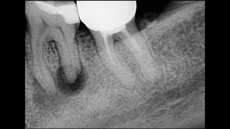 Fig. 4: Necrotic molar with a relatively large radiolucency. 