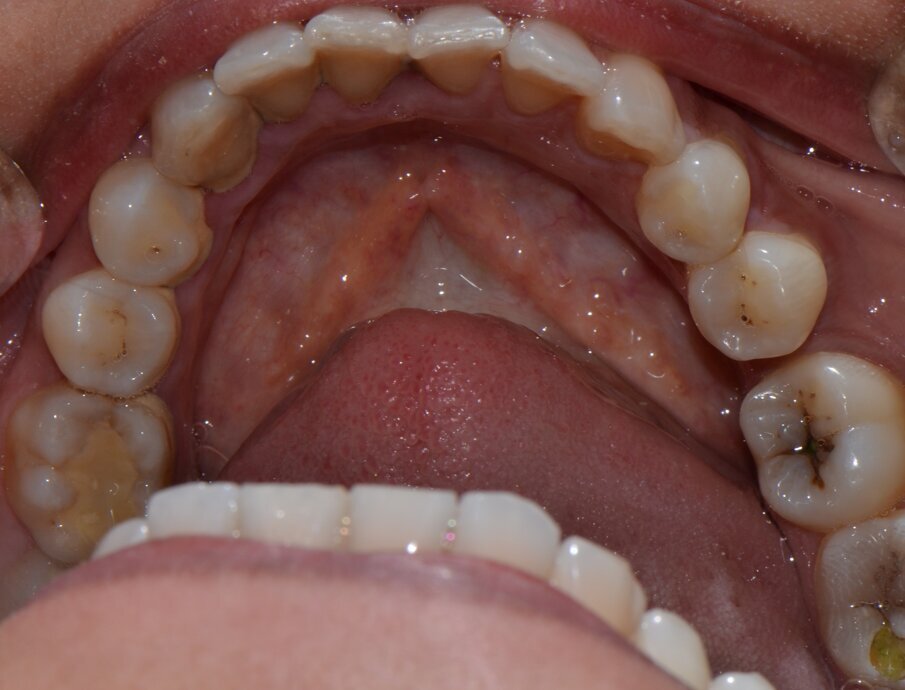 Fig 3: reduced edentulous space between 47 & 45