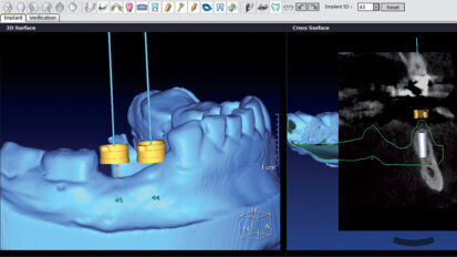 Implantologia digitale: risultati prevedibili estetici e funzionali