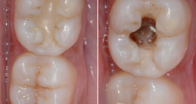 Replacement of a faulty posterior restoration