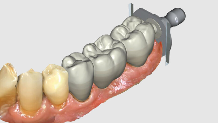 Fig. 6: Owing to the bright shade of the teeth in the cuspal area, the restoration was positioned high in the multilayered KATANA Zirconia Block.