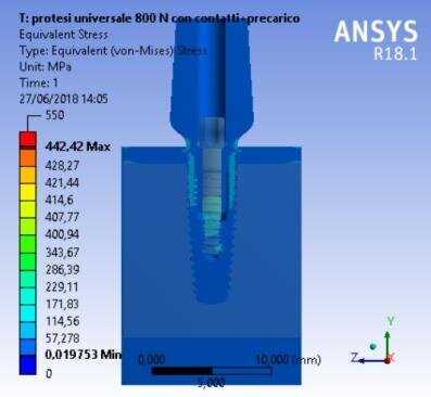 Fig. 9a - Von Mises results of the complex bone fixture and prosthodontics attachments, (a) universal prosthesis.