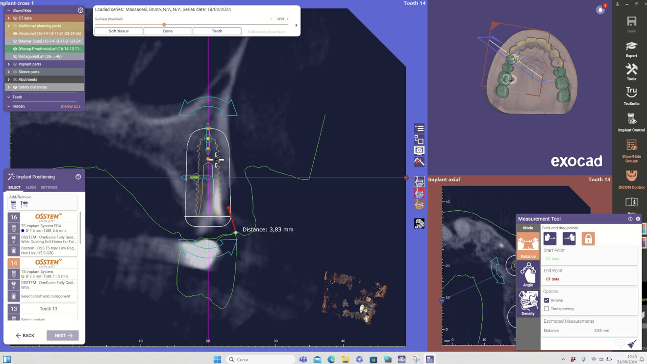 Fig. 4: Virtual implant planning of an immediate post-extraction site in exoplan 3.1.