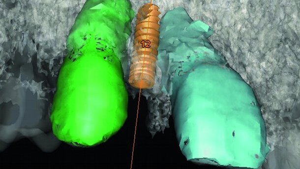 Implants de faible diamètre pour des édentements unitaires antérieurs