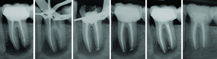 Fig. 1- Ritrattamento canalare 3.6 controllo a 5 anni.