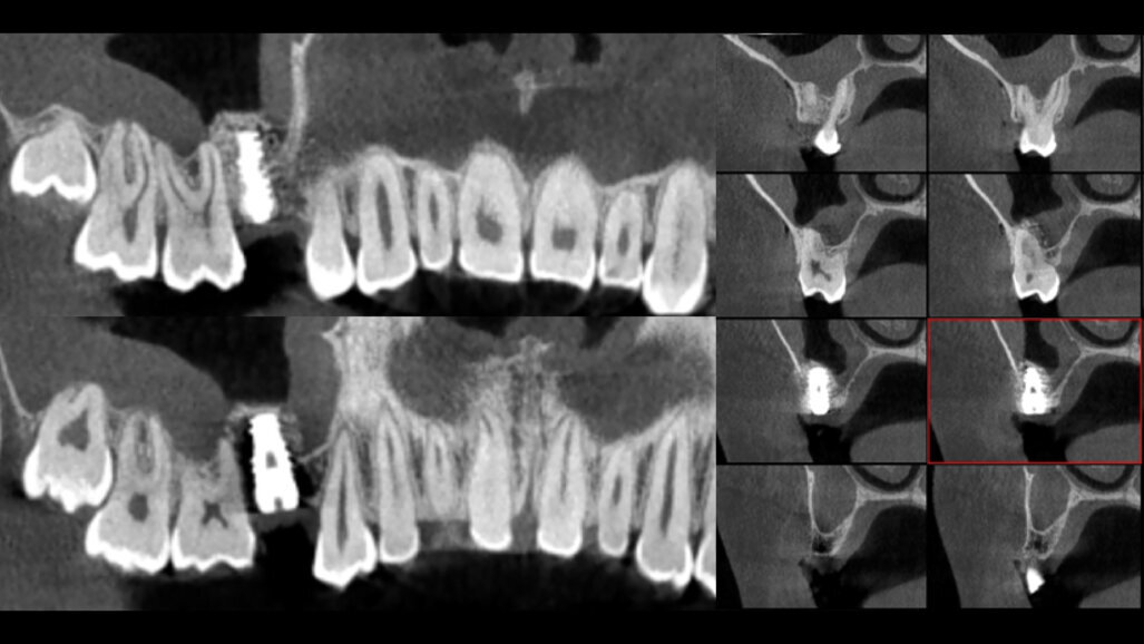 Augmentace sinu a současné zavedení implantátu za použití jednofázové sendvičové techniky