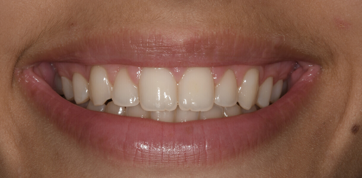 Fig. 18: Final intra-oral photograph. 
