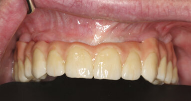 Immediate restoration of an edentulous maxilla