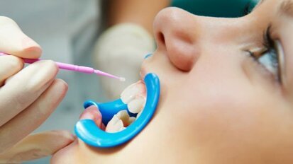 Превенция на зъбния кариес: дентални силанти или флуорни лакове?