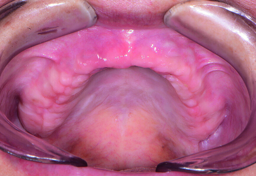 Fig. 17: Maxillary ridge four months post-op. 