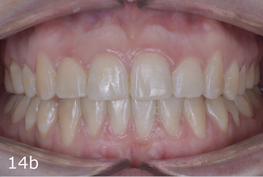 Figs. 14a–h: Intra-oral comparison of the situation (a, d, e & h) before and (b, c, f & g) after treatment.
