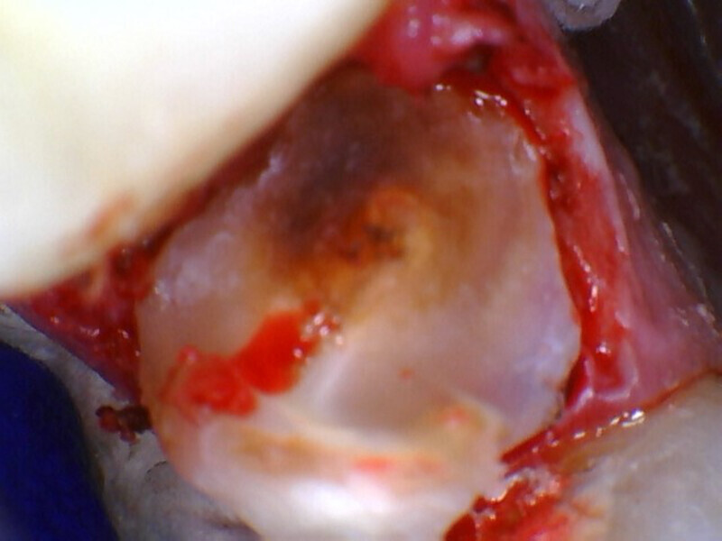 Fig. 14: Pulpal exposure after caries removal.