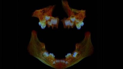 Anglo-Saxon teeth could help identify modern health issues, study finds