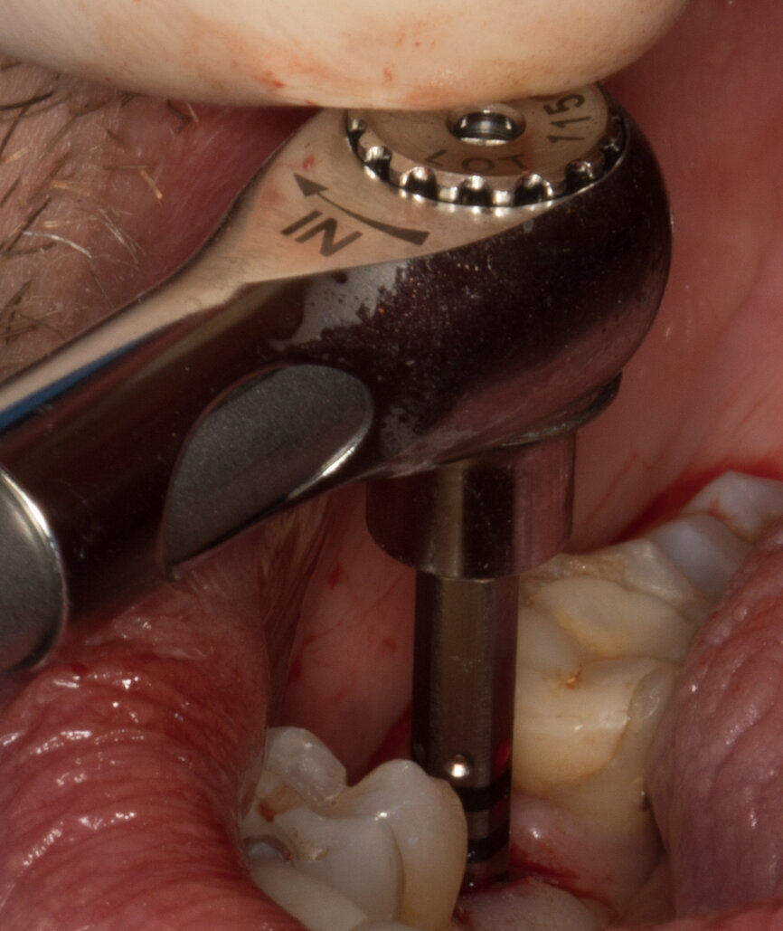 Ryc. 14_Dokręcenie implantu kluczem dynamometrycznym.